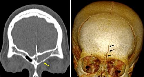 Linear skull fracture – Radiology Cases