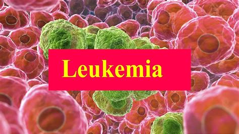 Leukemia Causes ,Symptom, Signs, Diagnosis, Prognosis, and Treatment