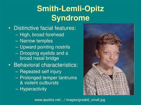 Smith lemli optiz syndrome - MEDizzy