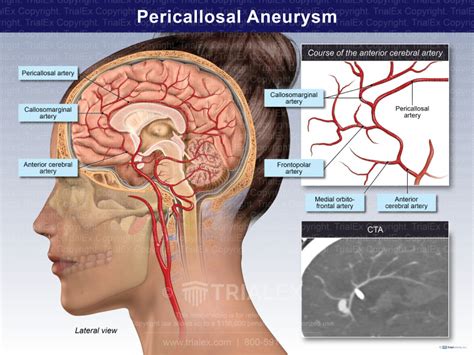 Pericallosal Aneurysm - TrialQuest Inc.