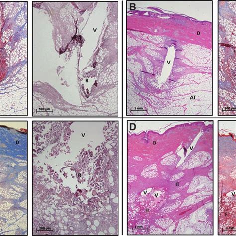 Examples of subcutaneous AT histology surrounding two CCs (A, B ...