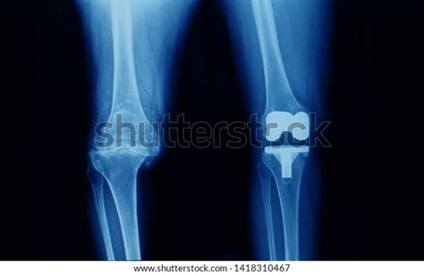 Xray Knee Showing Severe Osteoarthritis Varus Stock Photo (Edit Now ...