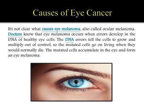 Eye Cancer (Eye Melanoma): Symptoms, Causes, Diagnosis and Treatment.