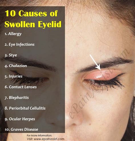 10 Causes of Swollen Eyelid & Its Treatment