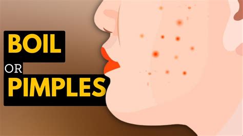 Boils vs. Pimples: What's the Difference and How to Treat Them - YouTube