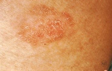 Skin Cancer – Types, Symptoms & Signs of Skin Cancer – The Silver Bird