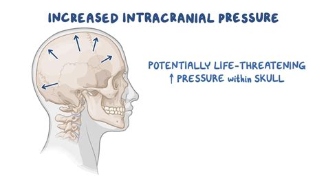 Increased intracranial pressure (ICP): Nursing - Biblioteca de Osmosis