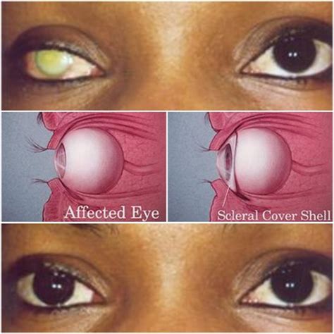 Scleral Cover Shell – Artificial Eyes Uganda