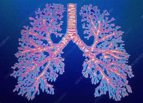 Bronchial tree of lungs - Stock Image - P580/0084 - Science Photo Library