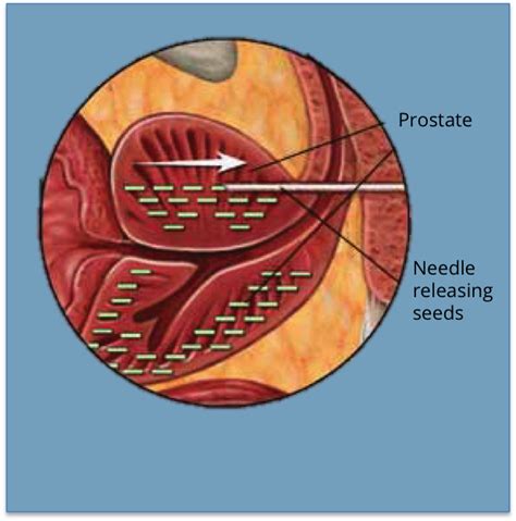 Education Center - Prostate Cancer Treatment Options | HIFU Prostate ...