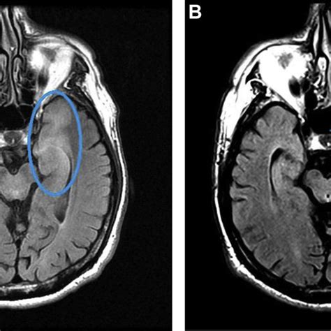 (PDF) MRI diagnosis of herpes simplex encephalitis in an elderly man ...