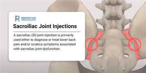 Sacroiliac Joint Injections - NJ's Top Orthopedic Spine & Pain ...