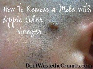 How to Remove a Mole with Apple Cider Vinegar | The Homestead Survival | Mole removal, Health ...