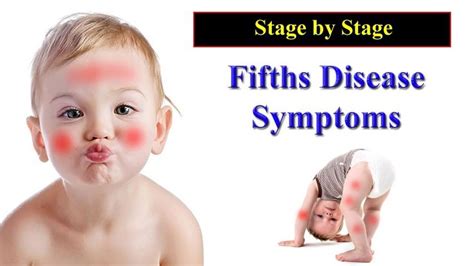 Fifths Disease Symptoms – Major Signs of Fifth Disease Stage by Stage fo... | Fifth disease ...