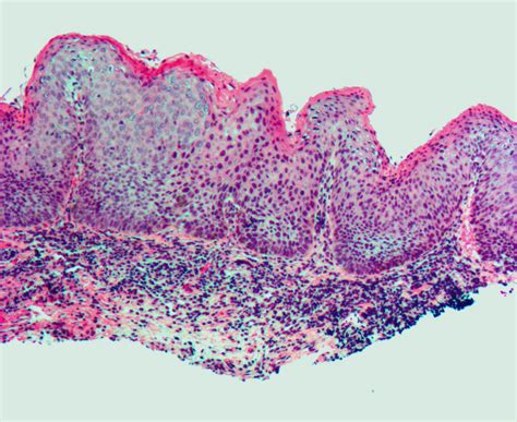 Vulvar intraepithelial Neoplasia(VIN) Pictures, Treatment, Symptoms