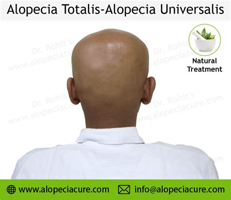 Alopecia Universalis