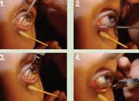 Learn How to Irrigate The Lacrimal System