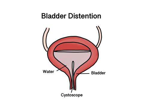 Interstitial Cystitis Treatment in Singapore - AARE Urocare | Dr Fiona