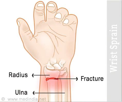 Wrist Sprain