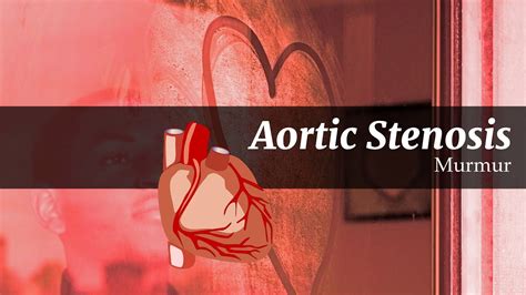 Aortic Stenosis | Causes | Symptoms & Signs | Examination | Ix and Mx # ...