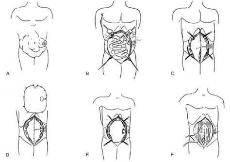 -Surgical technique. | Download Scientific Diagram