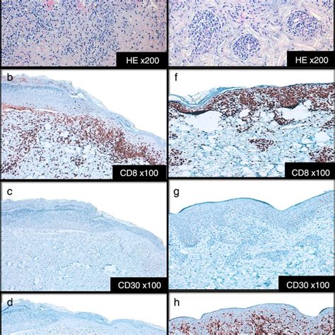 clinical presentation of PLEVA in patient 1 (a-b) and 2 (c-d) with... | Download Scientific Diagram