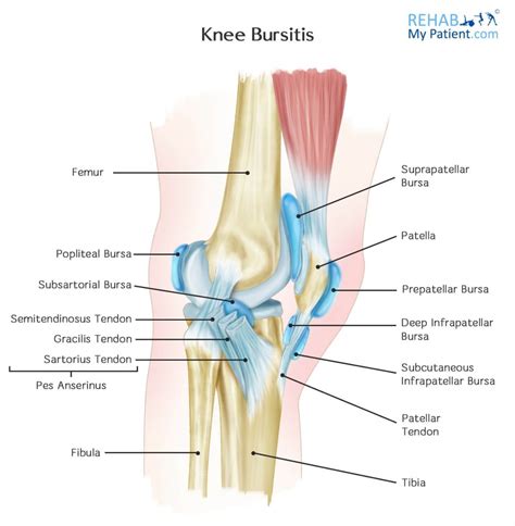 Knee Bursitis | Rehab My Patient