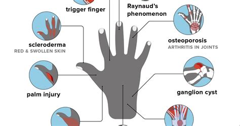 Hand pain: Causes, home remedies, and treatments