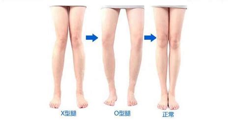 18 best Fix Bow-legged images on Pinterest | Surgery, Leg exercises and ...