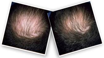 Men's Minoxidil Spray 5% Hair Regrowth Treatment | Minoxidil Spray