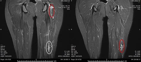 Sciatic Nerve Entrapment Neuropathy: A rare cause at a rare site | Eurorad