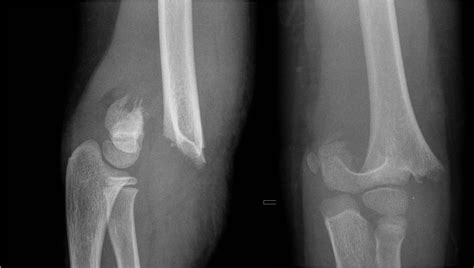 Fractures - Elbow