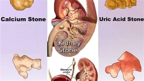 Human Kidney Stone