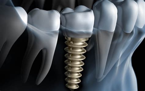 📍 Cómo es el proceso de colocación de un implante dental paso a paso