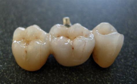 material - Why are porcelain teeth strong? - Physics Stack Exchange