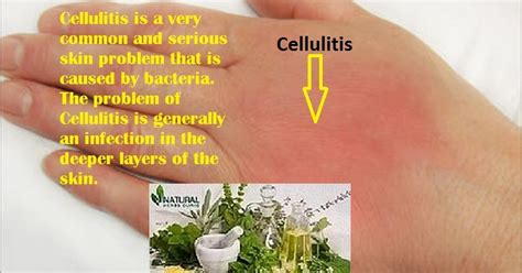 Cellulitis: Cellulitis Treatment At Home