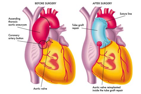 Aortic Valve Repair & Replacement Surgery in Mumbai, Aortic Valve ...