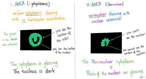 ANCA : Mnemonics | Epomedicine