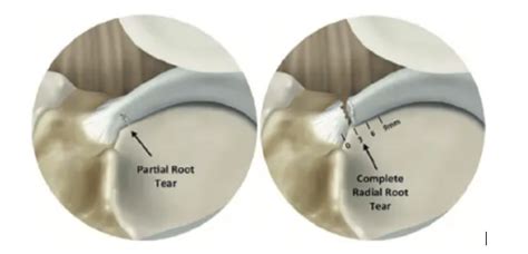 Meniscus Root Tear - Golden State Orthopedics & Spine