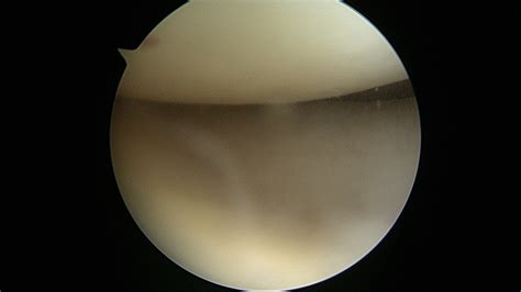 Normal cartilage femoral condyle - Arizona Institute for Sports, Knees and Shoulders