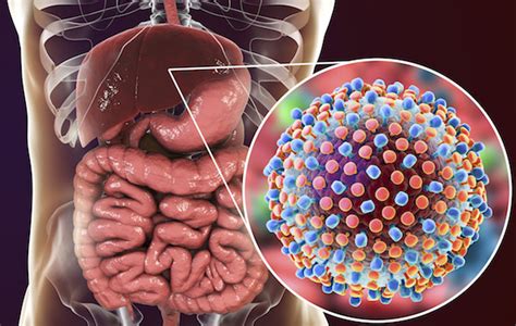 Hepatitis C Liver Disease