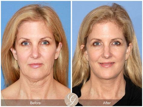 Neck Lift Before & After Photos From Dr. Kevin Sadati