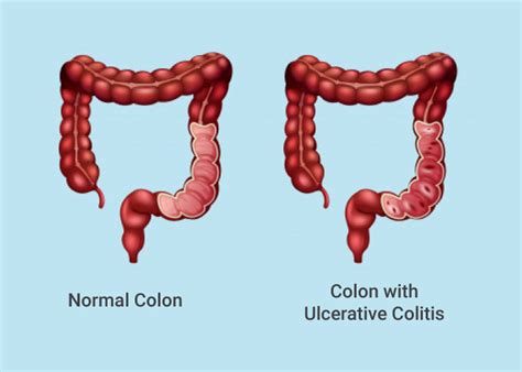 Ulcerative Colitis Skin Lesions