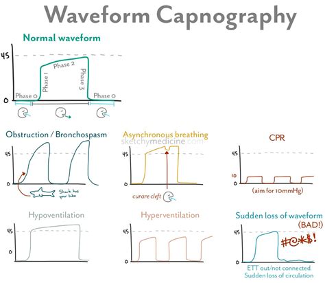 Waveform capnography is a commonly used monitor in the operating room ...