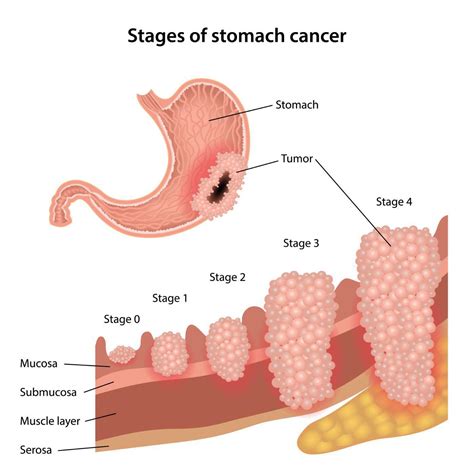 GERD or Stomach Cancer? Symptoms to Watch Out! - Women Fitness