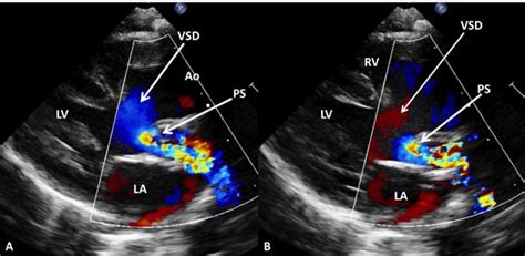 Transposition of the Great Arteries | Thoracic Key