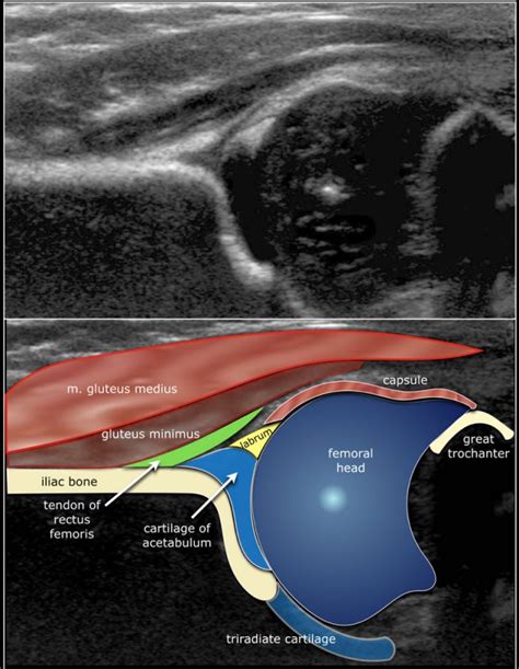 Developmental Dysplasia Of The Hip Ultrasound