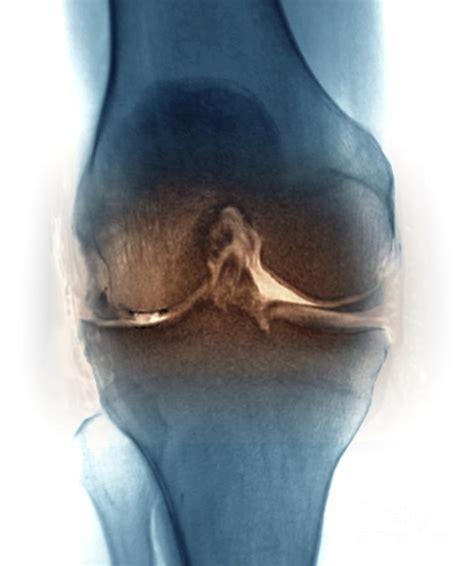 Osteoarthritis Of The Knee Joint #1 Photograph by Zephyr/science Photo Library - Pixels