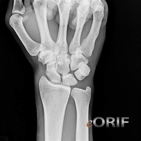 Wrist Xray | eORIF