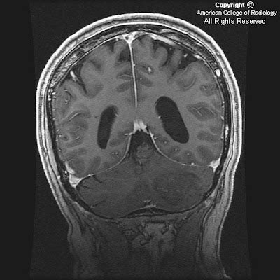 Neuroradiology On the Net: Lhermitte-Duclos disease (LDD)